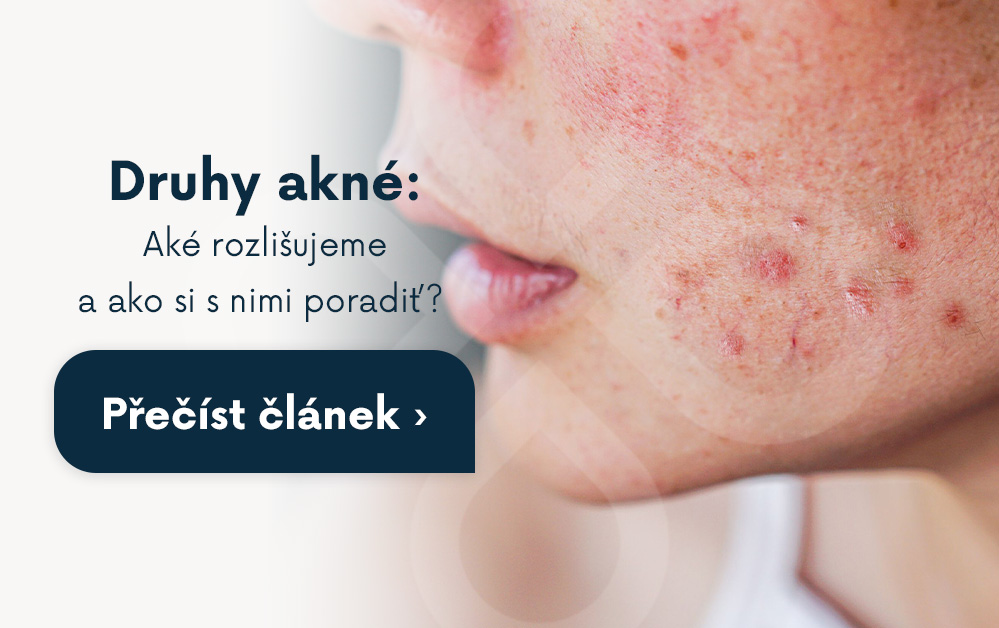 blog_CTA_mobil_druhy-akne